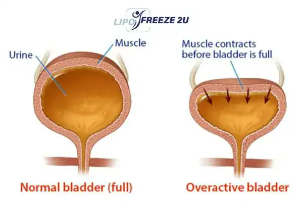 diagram of overactive bladder treatment Northolt