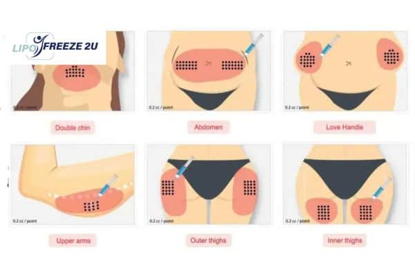 Benefits of Choosing Aqualyx for Fat Reduction Northolt