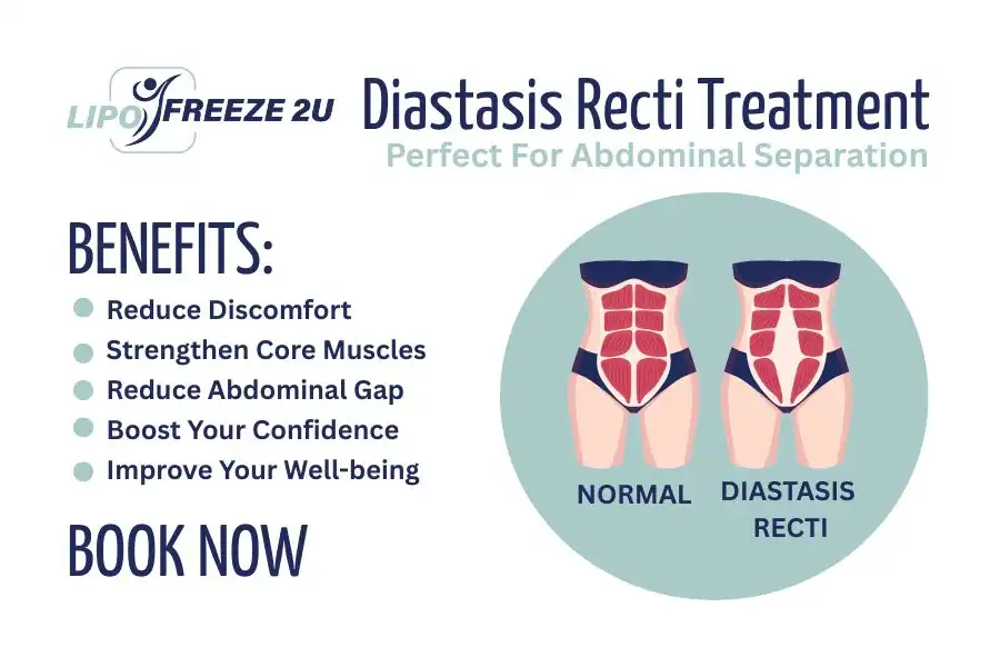 Benefits of body toning treatment Northolt for Diastasis recti