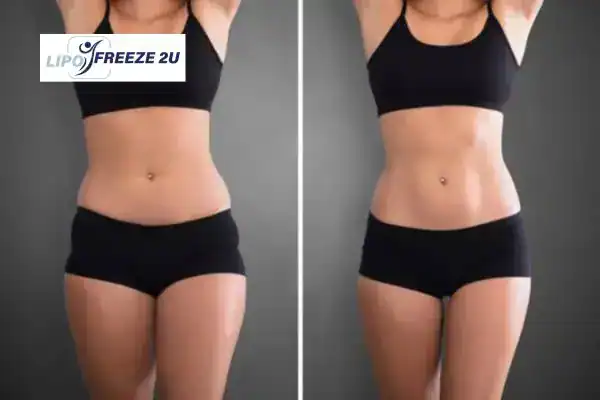 How Can LIPO FREEZE 2U Support Your Post-Pregnancy Body Recovery Northolt?