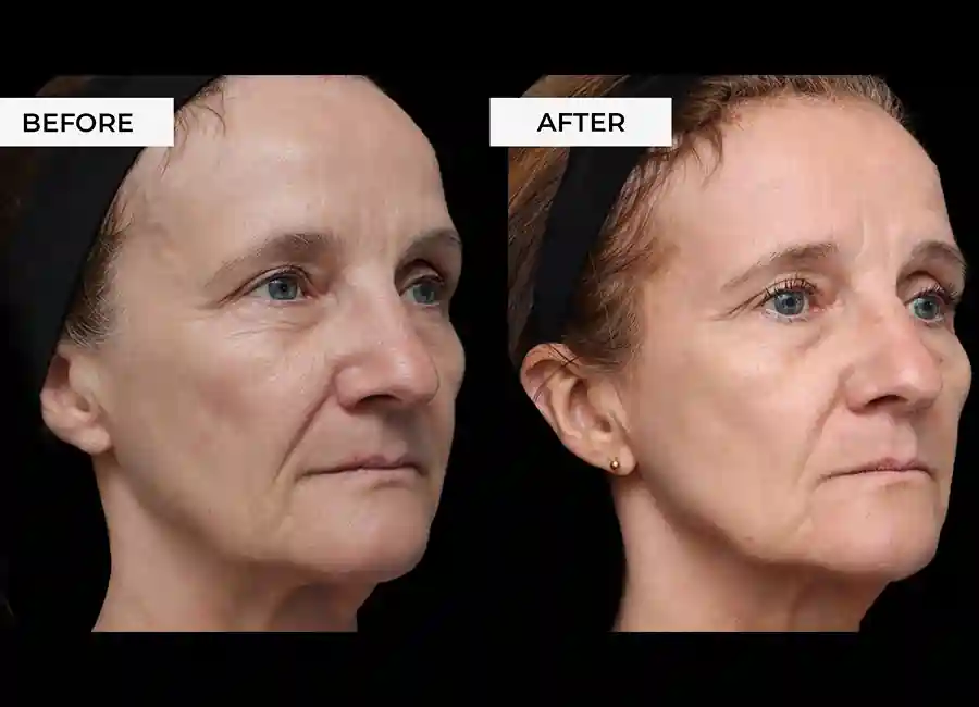 How Many RF Microneedling Sessions Will You Need to See a Difference Northolt?