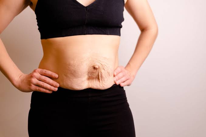 Is Surgery Really the Only Way to Repair Diastasis Recti Northolt?