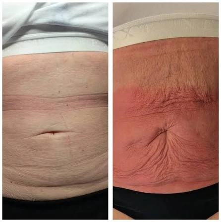 How Does RF Microneedling Improve Crepey, Thin and Uneven Skin Texture Northolt?