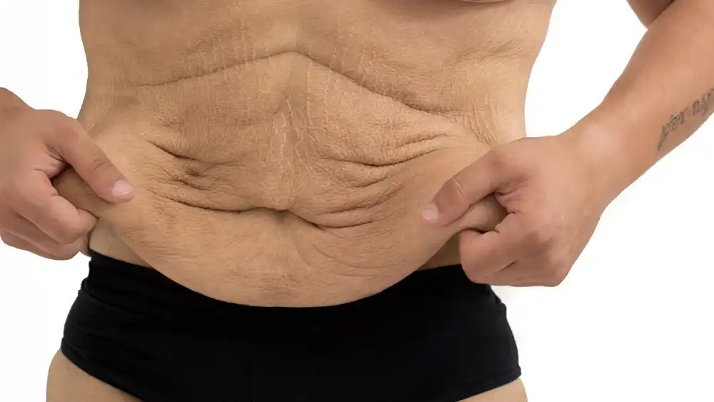 Why Does Weight Loss Medication Leave Some People With Loose or Sagging Skin Northolt?